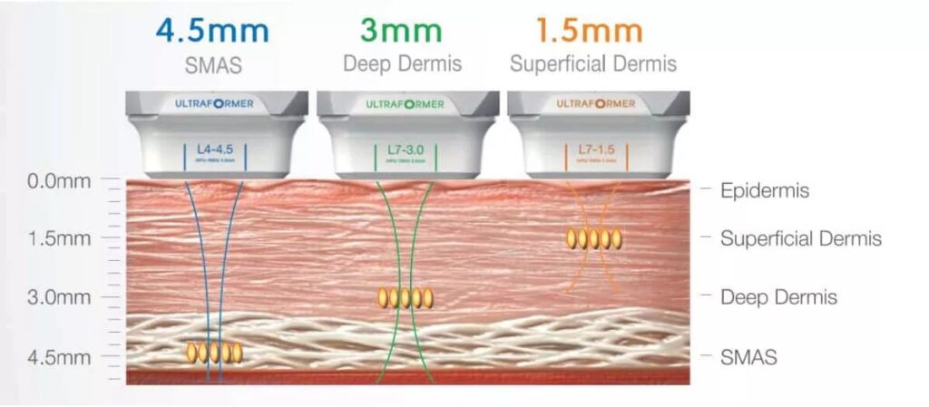 Ultherapy Depth Treatment