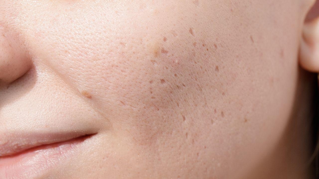 Pimples Scarring