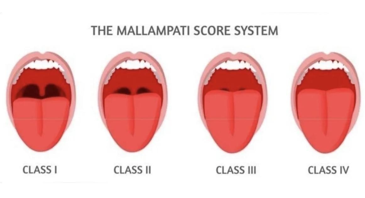 Mallampati Score System