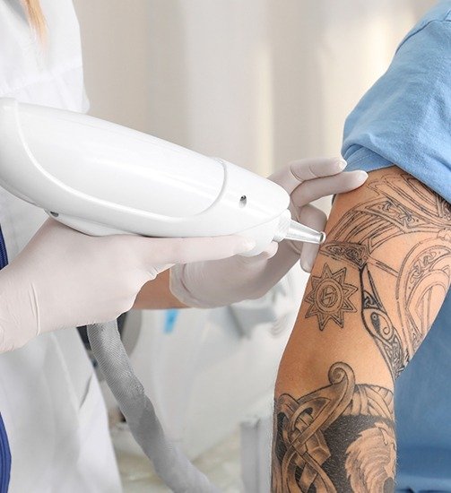 Tattoo Removal Laser Treatment 2